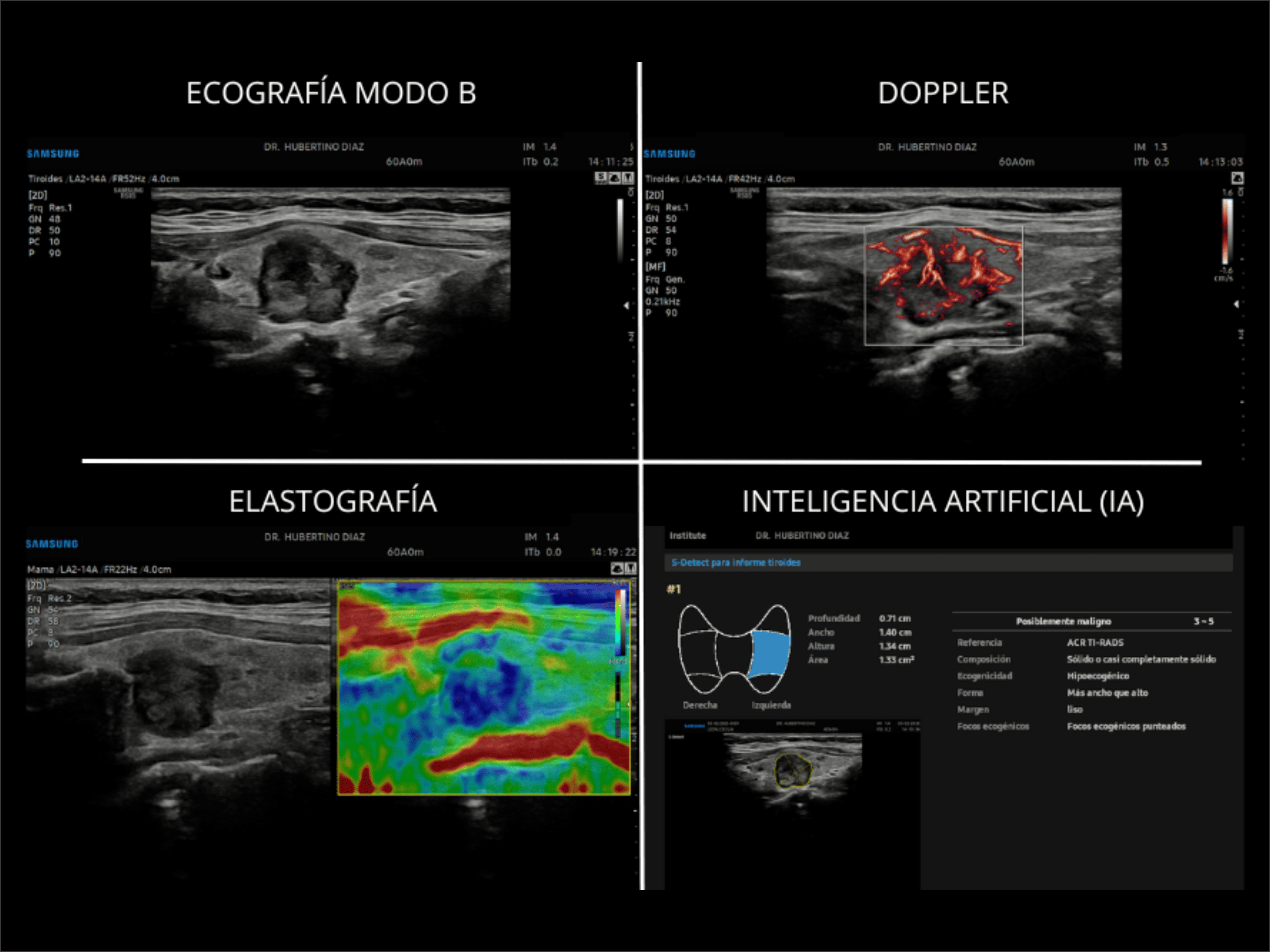 ECOGRAFÍA MULTIPARAMÉTRICA DE TIROIDES