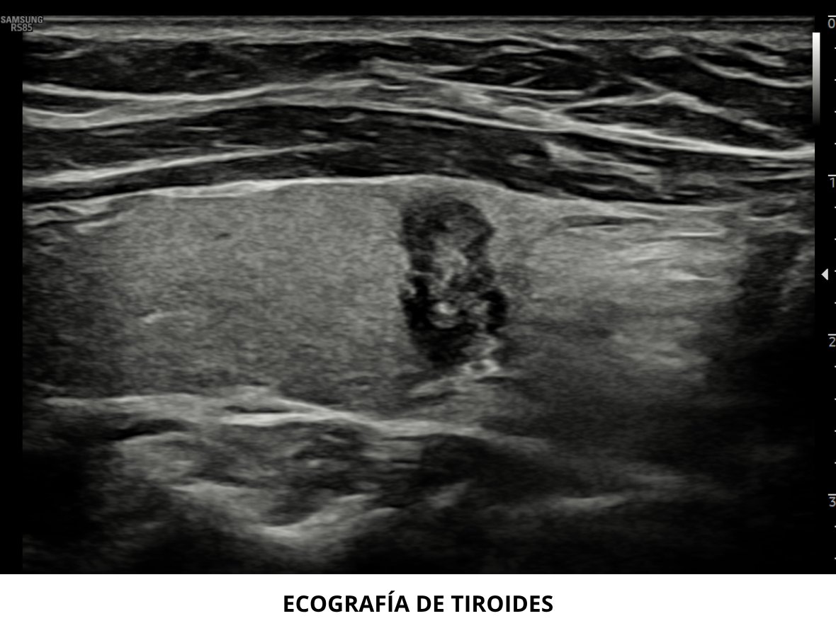 ECOGRAFÍA DE TIROIDES