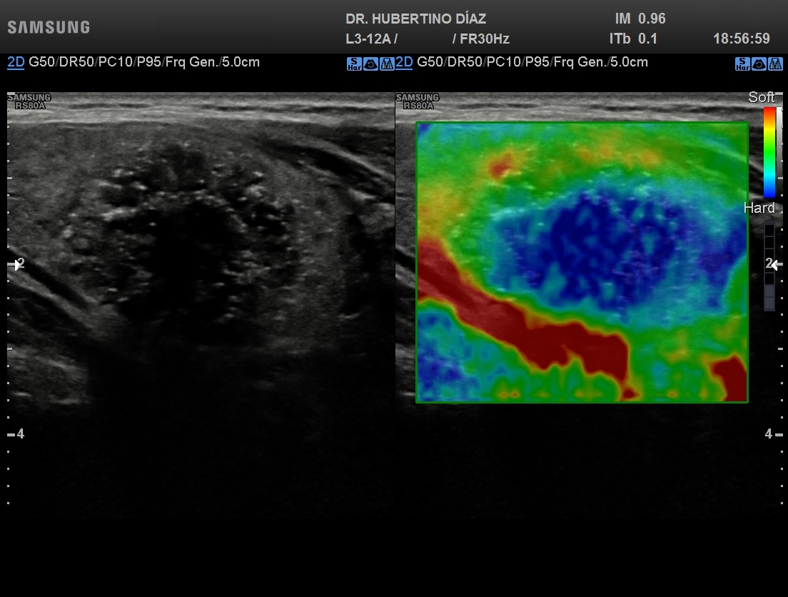 ELASTOGRAFÍA DE TIROIDES