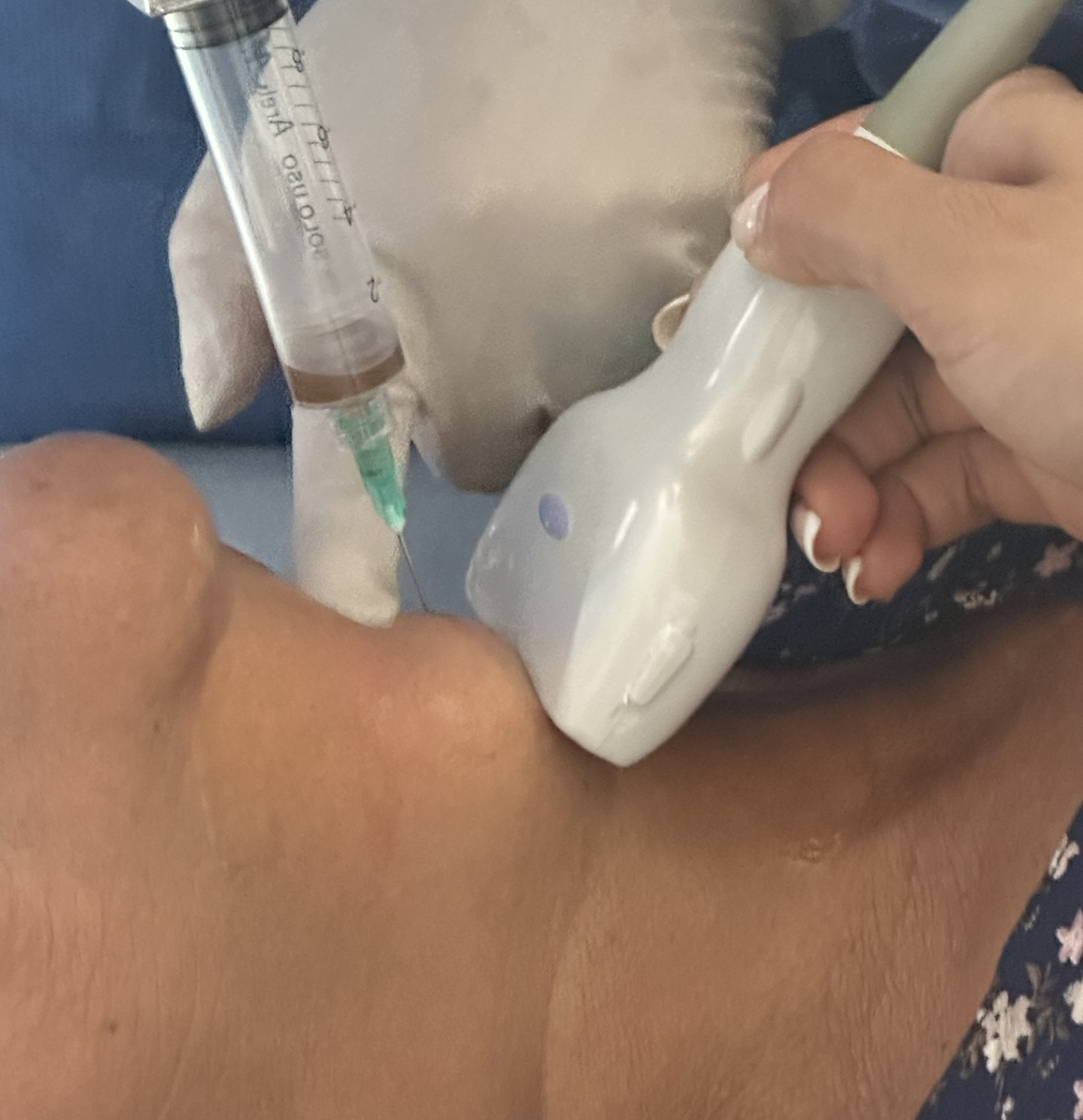 BIOPSIA ASPIRACIÓN CON AGUJA FINA (BAAF) CON GUIA ECOGRÁFICA DE TIROIDES