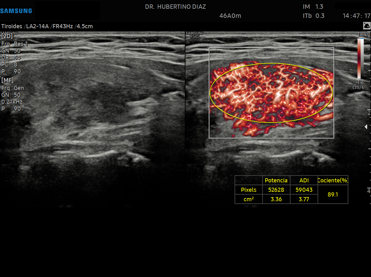 ECOGRAFÍA DOPPLER DE TIROIDES