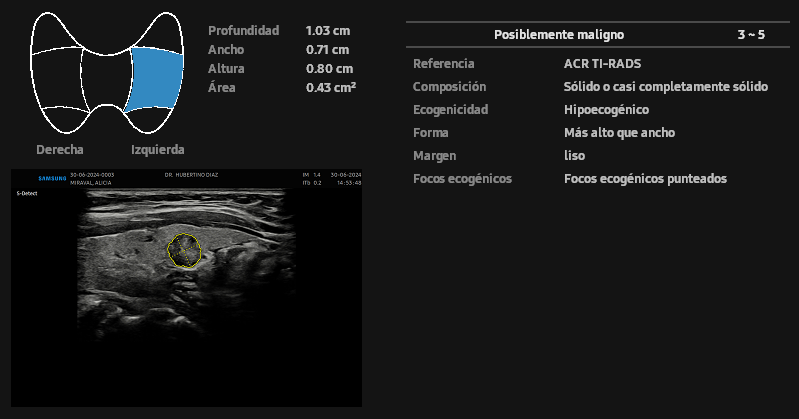 ECOGRAFÍA DE TIROIDES CON INTELIGENCIA ARTIFICIAL