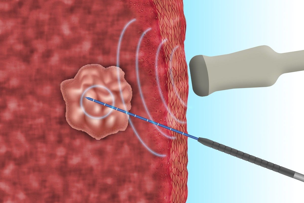 ABLACIÓN POR RADIOFRECUENCIA DE TIROIDES